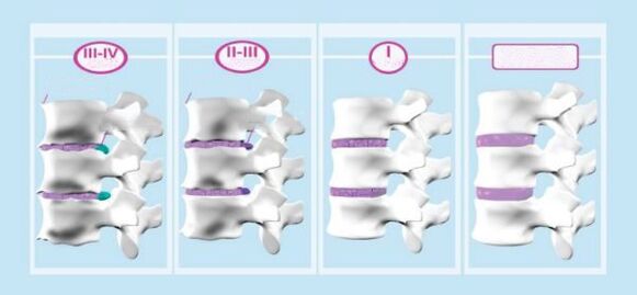 Марҳилаҳои остеохондроз