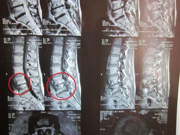 Ташхиси остеохондроз