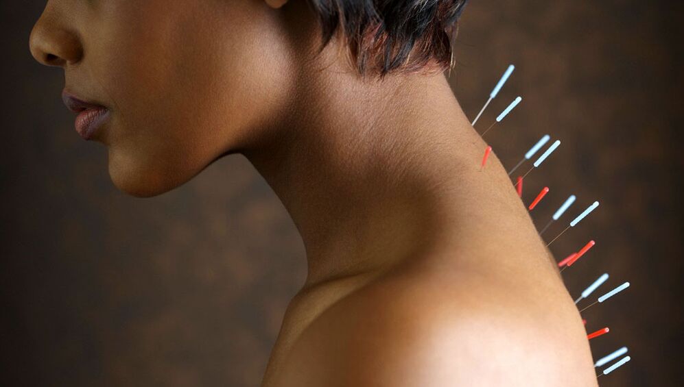 акупунктура бо остеохондрозҳои бачадон