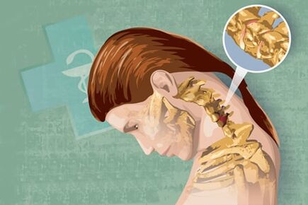 Аломатҳои рефлексҳои остеохондроз